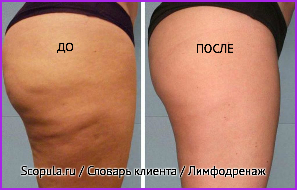 лимфодренаж до и после