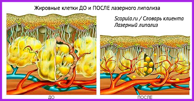 лазерный липолиз
